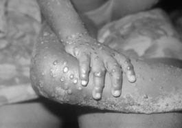 Monkeypox